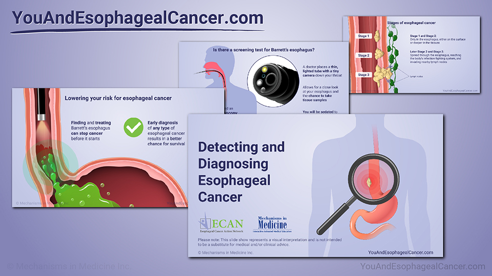 Slide Show - Detecting and Diagnosing Esophageal Cancer