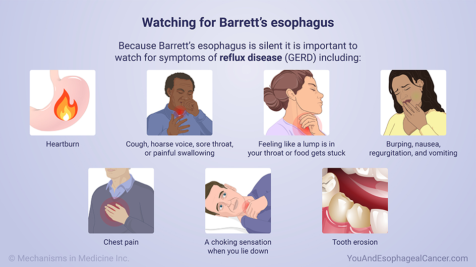 Watching for Barrett’s esophagus