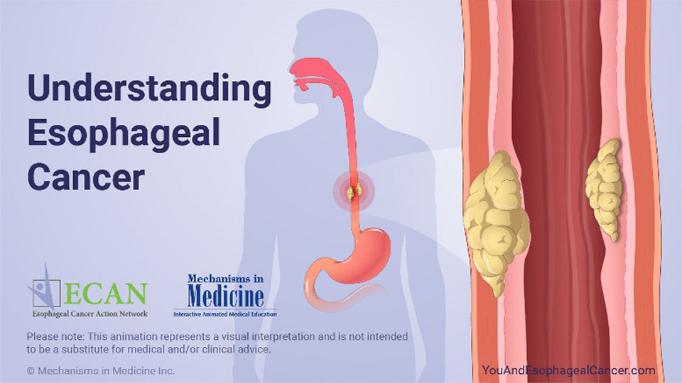 Understanding Esophageal Cancer