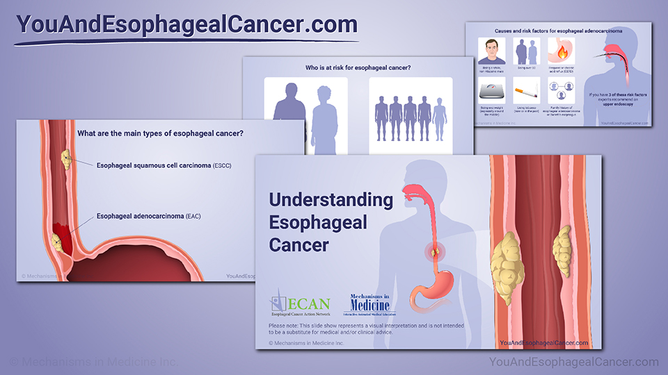 Slide Show - Understanding Esophageal Cancer