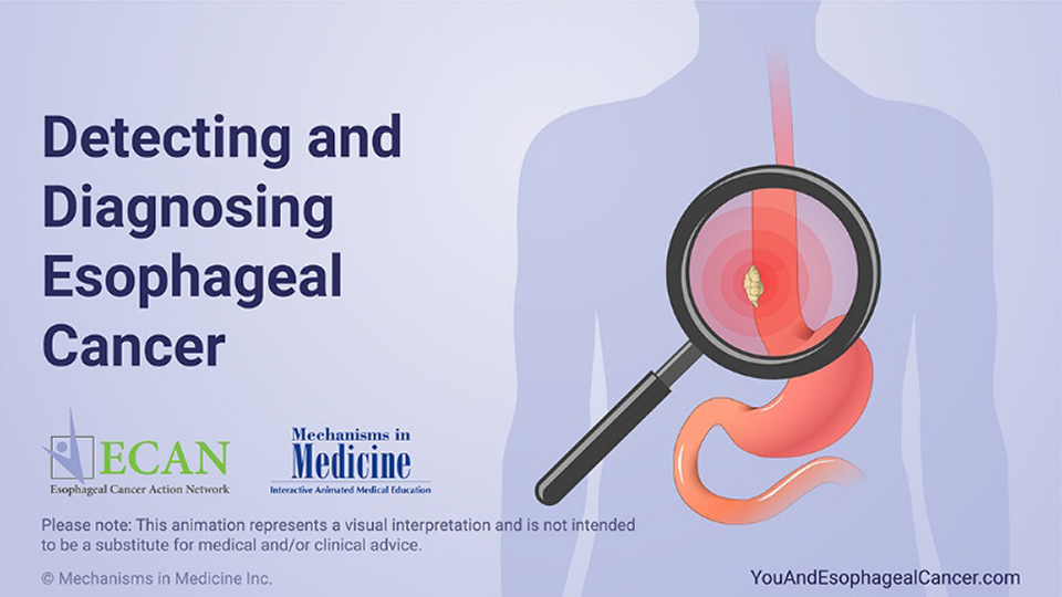 Animation - Detecting and Diagnosing Esophageal Cancer