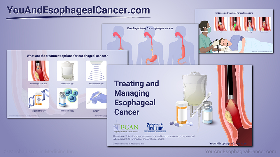 Slide Show - Treating and Managing Esophageal Cancer