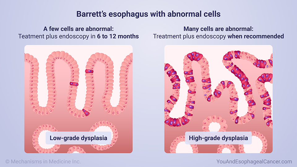 Barrett’s esophagus with abnormal cells