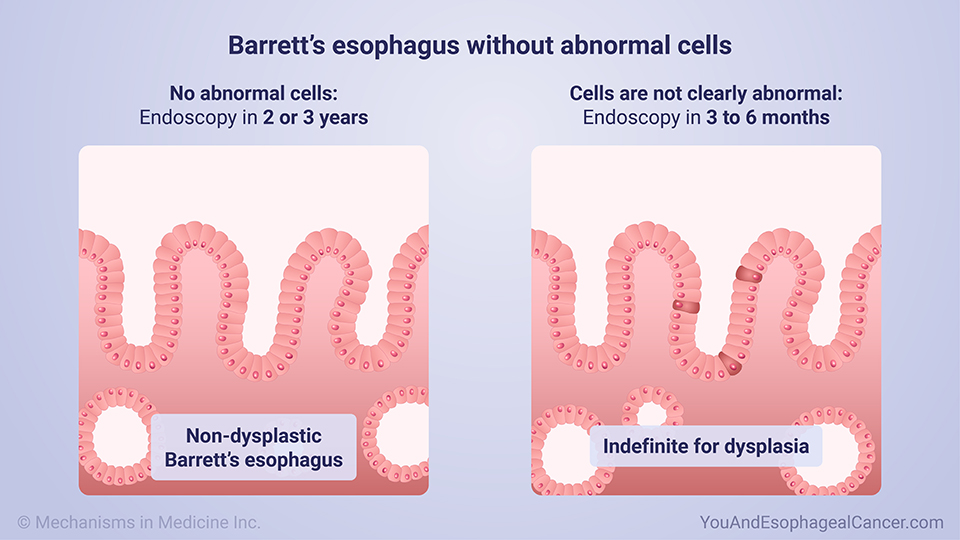 Barrett’s esophagus without abnormal cells