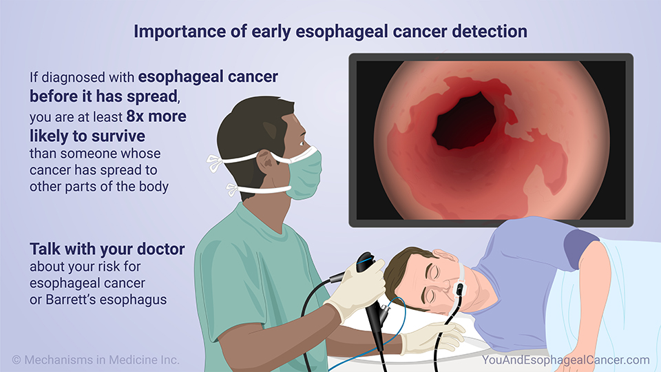 Importance of early esophageal cancer detection
