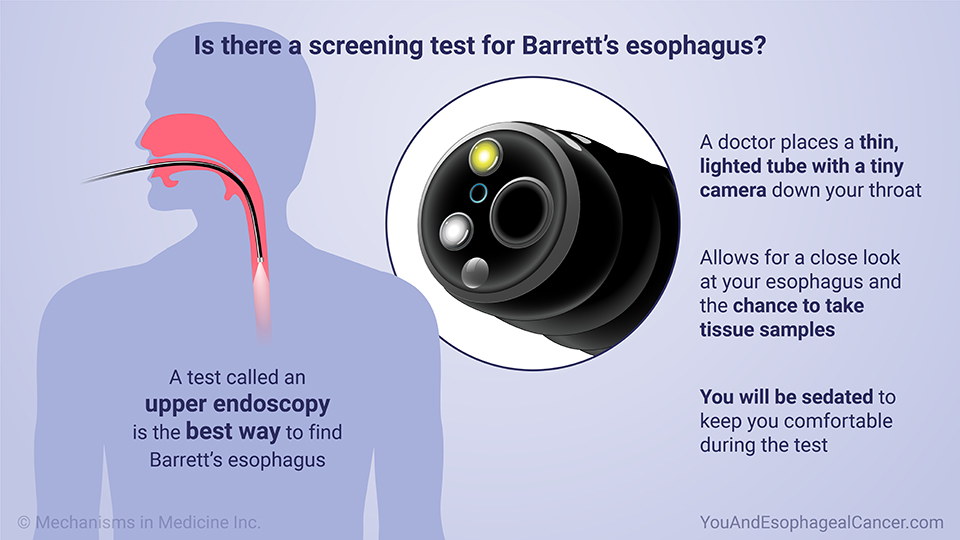 Is there a screening test for Barrett’s esophagus?
