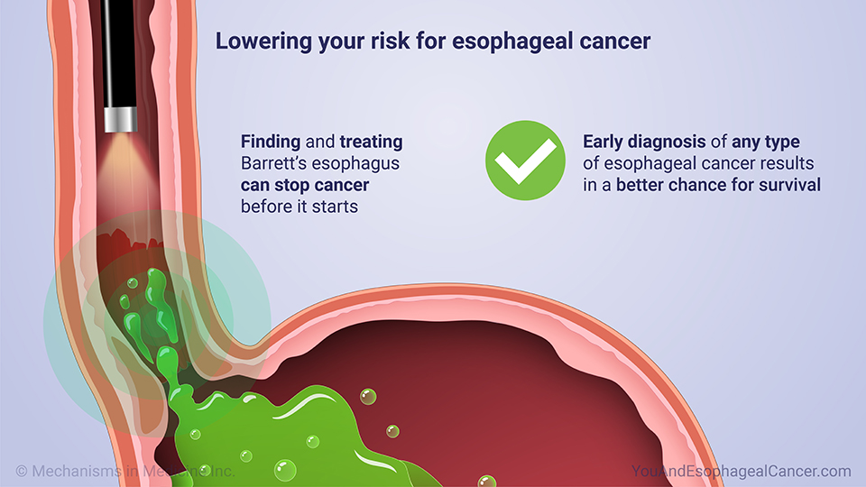 Lowering your risk for esophageal cancer