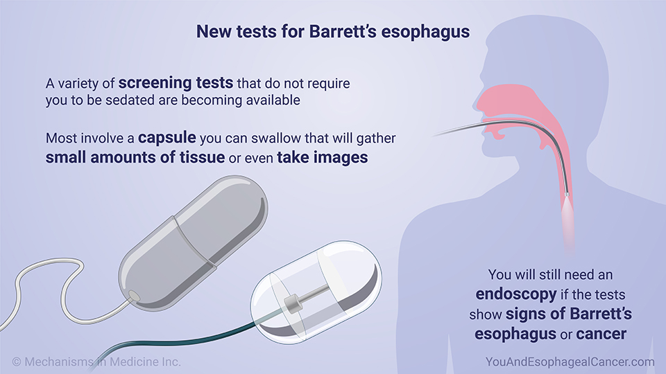 New tests for Barrett’s esophagus