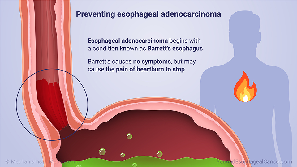 Preventing esophageal adenocarcinoma