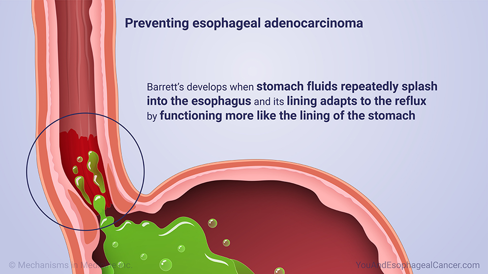 Preventing esophageal adenocarcinoma