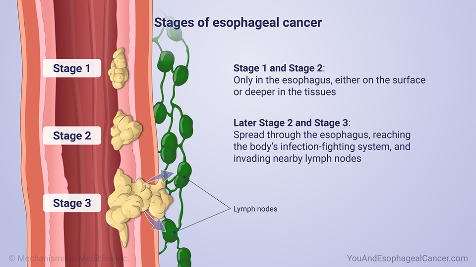 Stages of esophageal cancer