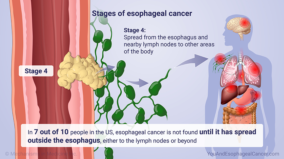 Stages of esophageal cancer 