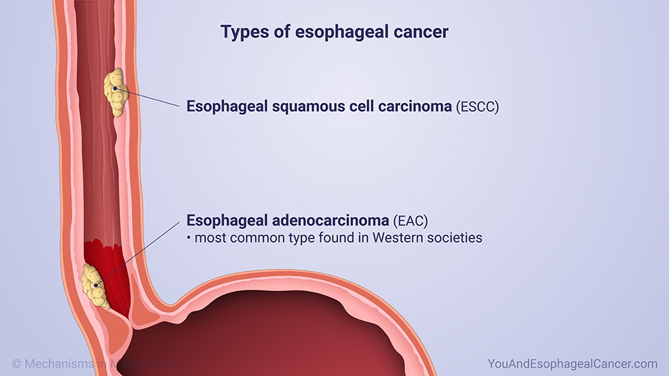 Types of esophageal cancer