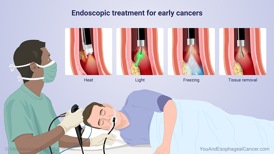 Endoscopic treatment for early cancers