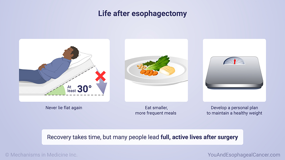 Life after esophagectomy