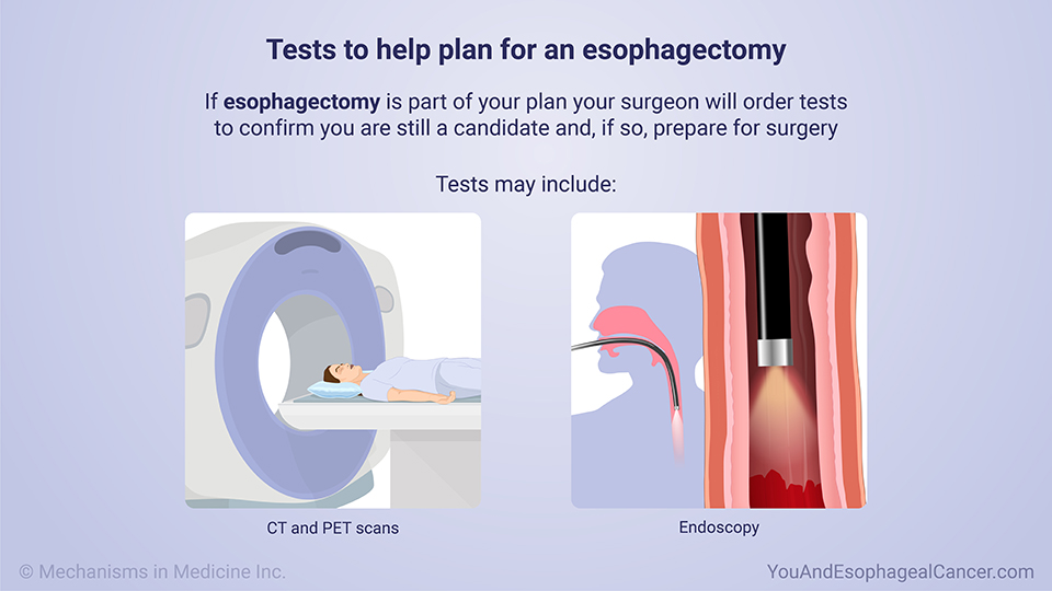 Tests to help plan for an esophagectomy