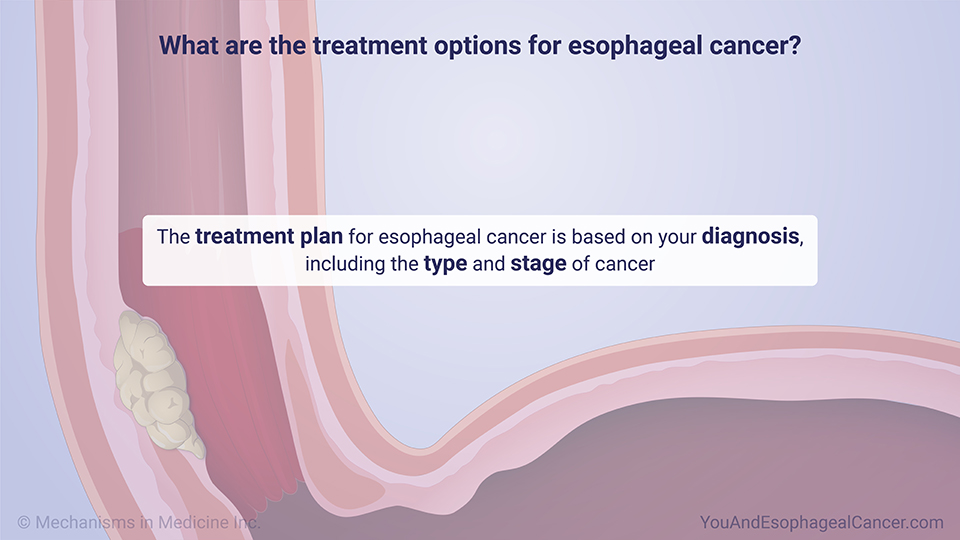 What are the treatment options for esophageal cancer?