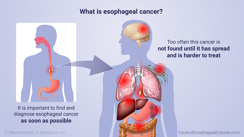 What is esophageal cancer?