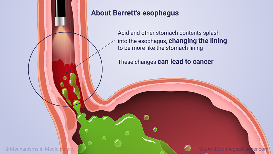 About Barrett’s esophagus