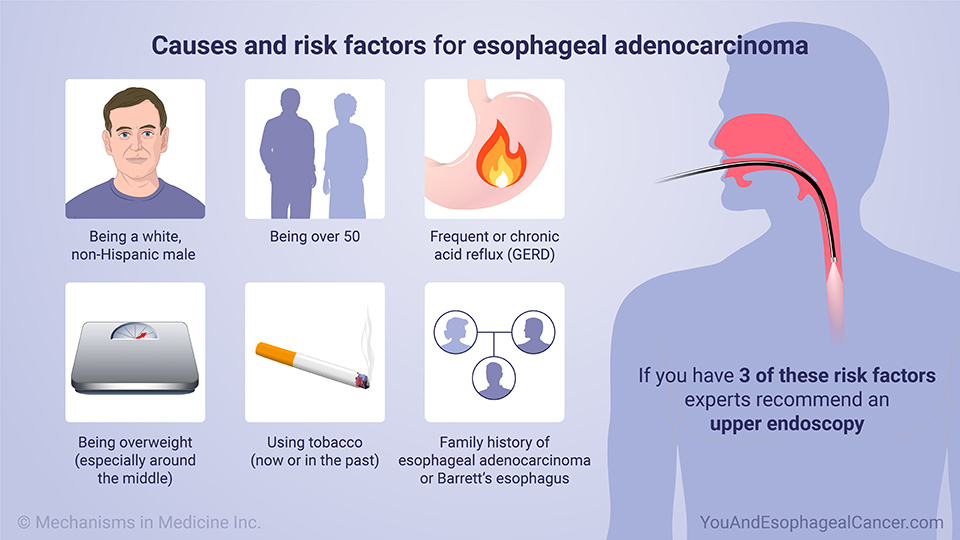 Causes and risk factors for esophageal adenocarcinoma (EAC)