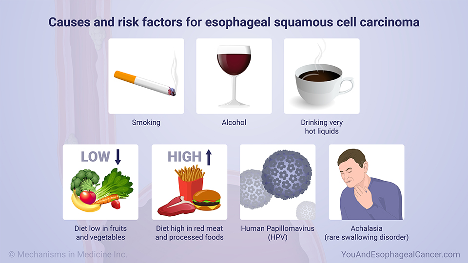 Causes and risk factors for esophageal squamous cell carcinoma (ESCC)
