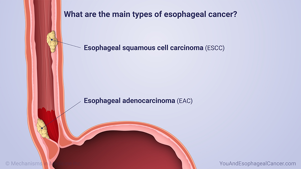 What are the main types of esophageal cancer?