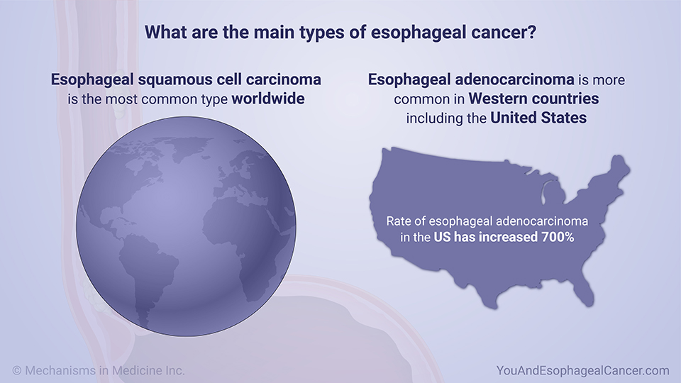 What are the main types of esophageal cancer?