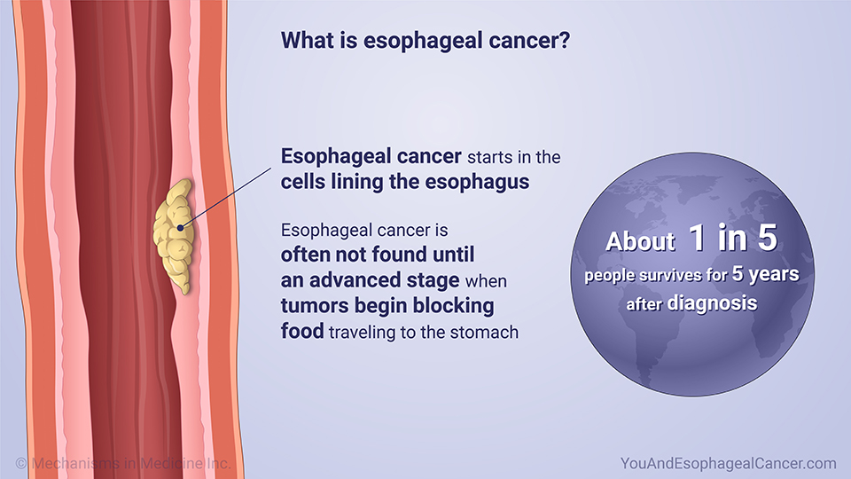 What is esophageal cancer?