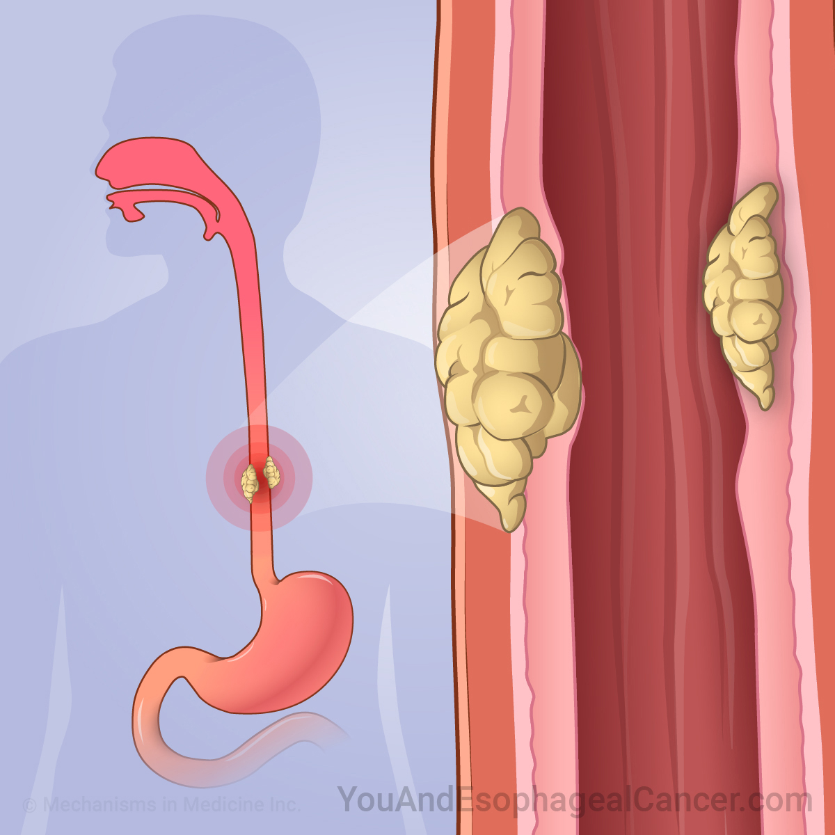 Understanding Esophageal Cancer with Constipation