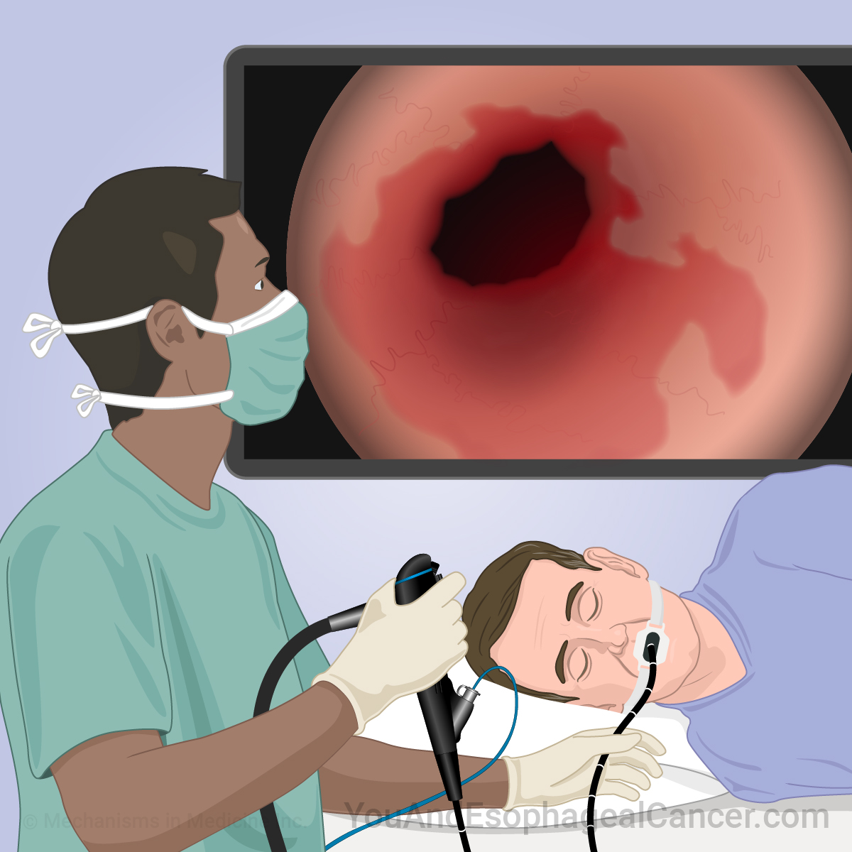 Learn about a variety of topics on Esophageal Cancer through short animations